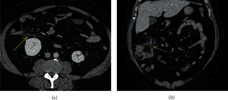 Appendiceal Intraluminal Gas: A CT Marker for Gangrenous Appendicitis.