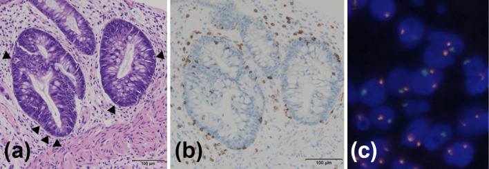Severe graft-versus-host disease of the lower intestinal tract after pomalidomide administration in a plasma cell leukemia patient following bone marrow transplantation.