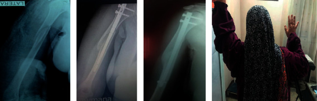 Assessment of Shoulder Function after Internal Fixation of Humeral Diaphyseal Fractures in Young Adults: A Prospective Comparative Study.