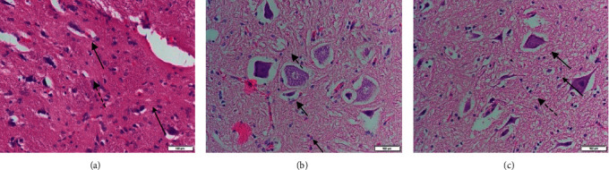 Protective Effect of Hyperbaric Oxygen Treatment on Axon Degeneration after Acute Motor Axonal Neuropathy.