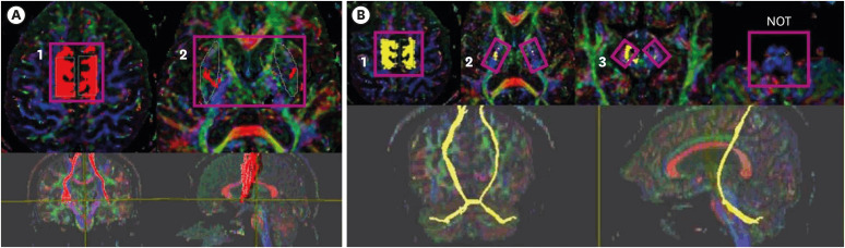 Role of Cortico-ponto-cerebellar Tract from Supplementary Motor Area in Ataxic Hemiparesis of Supratentorial Stroke Patients.