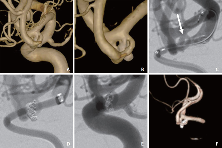 Use of Distal Intracranial Catheters for Better Working View of Cerebral Aneurysms Hidden by Parent Artery or Its Branches: A Technical Note.