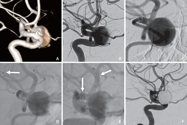 Use of Distal Intracranial Catheters for Better Working View of Cerebral Aneurysms Hidden by Parent Artery or Its Branches: A Technical Note.