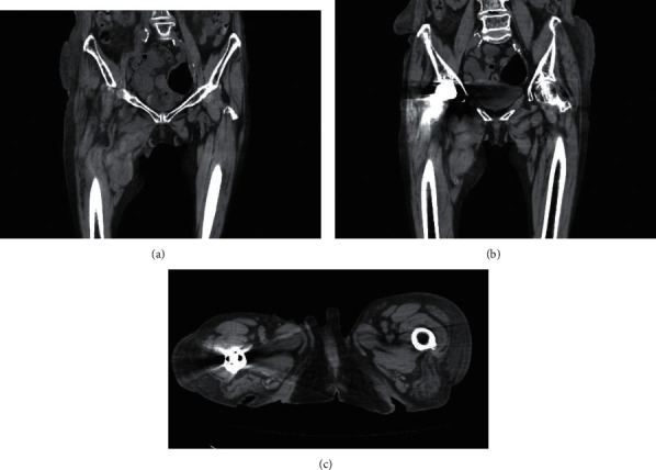 A Case Report of Femoral Hematoma following Obturator Nerve Block.