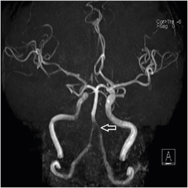 Sick Sinus Syndrome Combined with Wallenberg Syndrome: a Case Report.