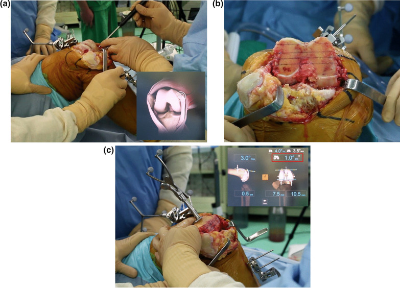 Appropriate determination of the surgical transepicondylar axis can be achieved following distal femur resection in navigation-assisted total knee arthroplasty.