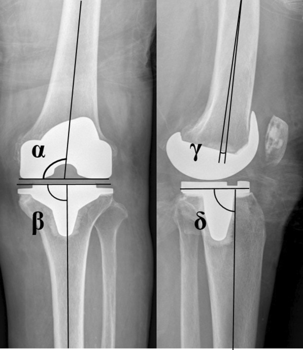 Appropriate determination of the surgical transepicondylar axis can be achieved following distal femur resection in navigation-assisted total knee arthroplasty.