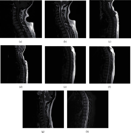 Recurrent Solitary Fibrous Tumor in Intradural Extramedullary Space: Case Report and Review of the Literature.