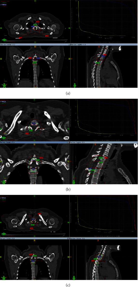 Recurrent Solitary Fibrous Tumor in Intradural Extramedullary Space: Case Report and Review of the Literature.