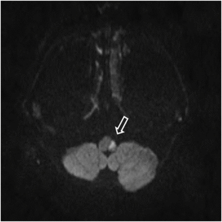 Sick Sinus Syndrome Combined with Wallenberg Syndrome: a Case Report.