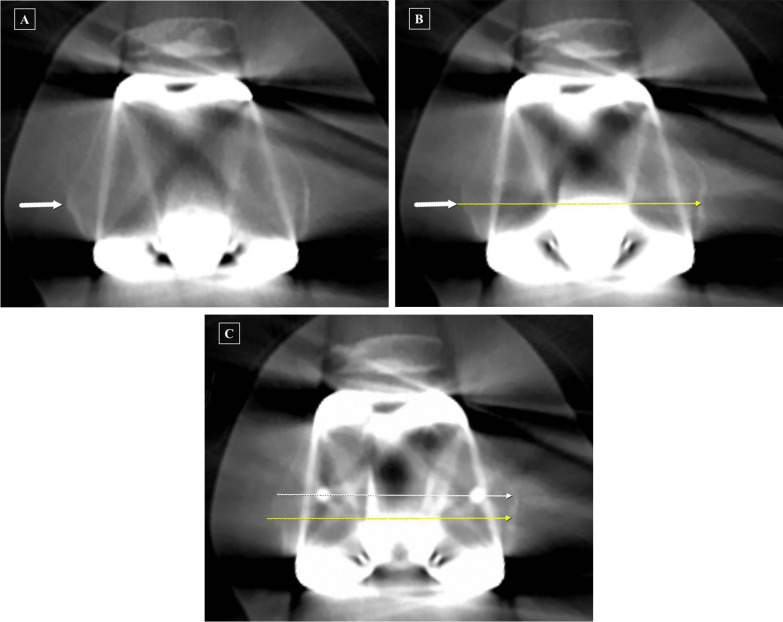 Appropriate determination of the surgical transepicondylar axis can be achieved following distal femur resection in navigation-assisted total knee arthroplasty.