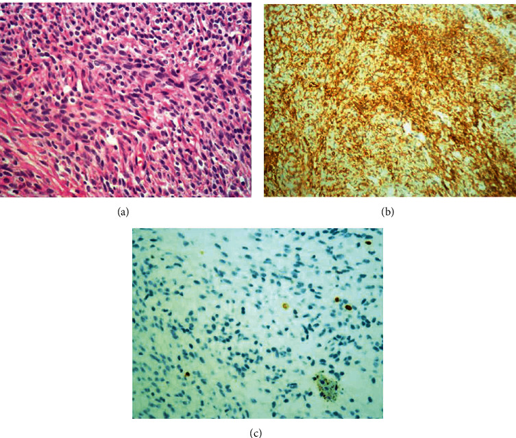 Recurrent Solitary Fibrous Tumor in Intradural Extramedullary Space: Case Report and Review of the Literature.