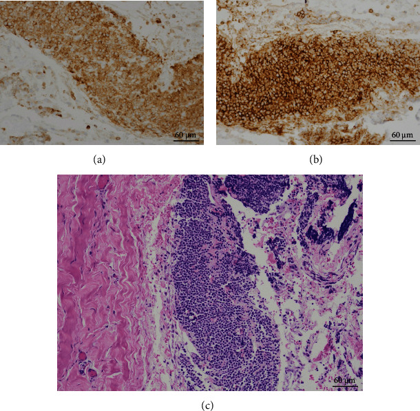 Pericardial Relapse of Acute Lymphoblastic Leukemia (ALL).