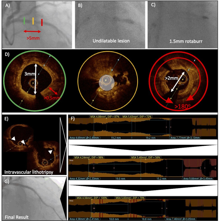 A Vision Of Percutaneous Coronary Revascularisation In 2021: How to take advantage of intra-coronary imaging to perform more effective PCI.