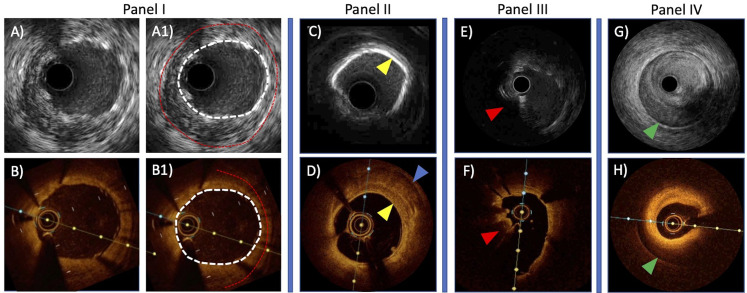 A Vision Of Percutaneous Coronary Revascularisation In 2021: How to take advantage of intra-coronary imaging to perform more effective PCI.