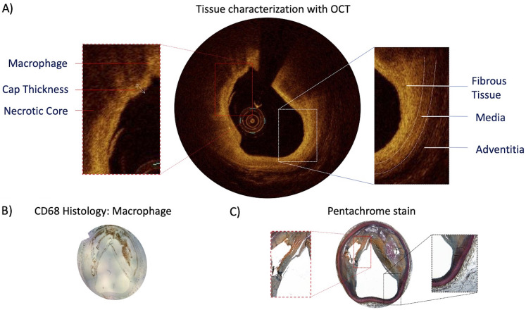 A Vision Of Percutaneous Coronary Revascularisation In 2021: How to take advantage of intra-coronary imaging to perform more effective PCI.