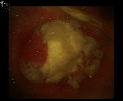 Robotic Partial Cystectomy for Urachal Carcinoma: A Case Report and Review of the Literature.