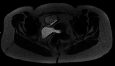 Robotic Partial Cystectomy for Urachal Carcinoma: A Case Report and Review of the Literature.