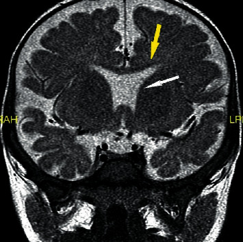 Septo-Optic Dysplasia Diagnosed in a Newborn Infant with Normoglycemia: The Importance of Thorough Physical Examination.