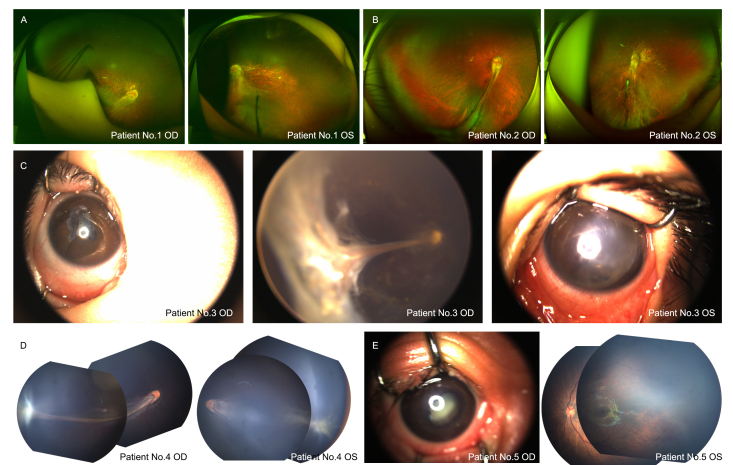 Five novel copy number variations detected in patients with familial exudative vitreoretinopathy.