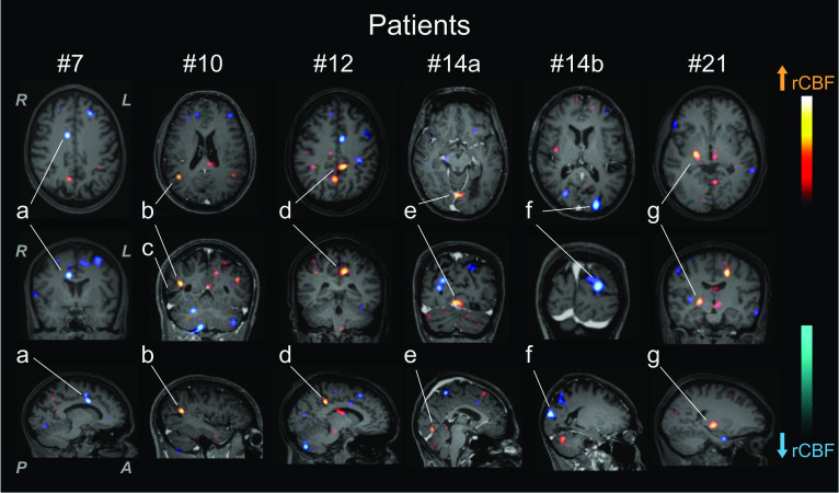 Temporal and spatial changes in cerebral blood flow in neuropsychiatric systemic lupus erythematosus: a subtraction brain spect study.