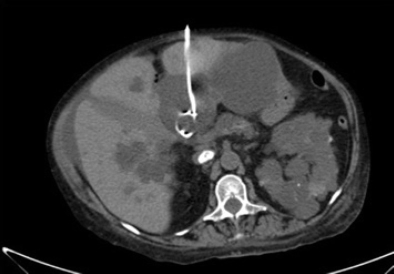 Incoercible Vomiting in a Polycystic (ADPKD) Patient on Peritoneal Dialysis.