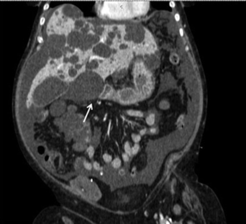 Incoercible Vomiting in a Polycystic (ADPKD) Patient on Peritoneal Dialysis.