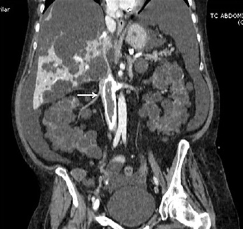 Incoercible Vomiting in a Polycystic (ADPKD) Patient on Peritoneal Dialysis.