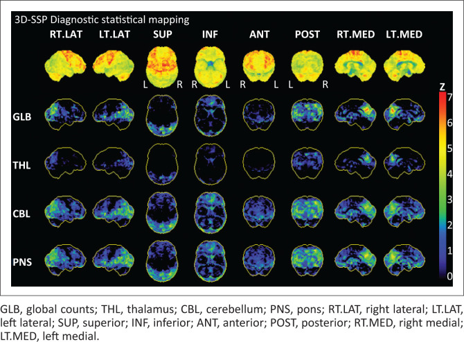 PET-CT in brain disorders: The South African context.