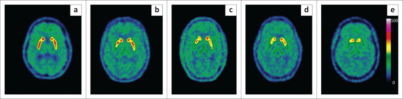 PET-CT in brain disorders: The South African context.