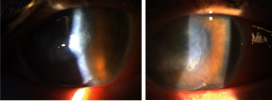 Combined <i>Rothia dentocariosa</i> and <i>Streptococcus viridans</i> Corneal Ulcer in an Immunocompromised Patient.