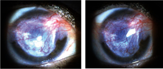 Combined <i>Rothia dentocariosa</i> and <i>Streptococcus viridans</i> Corneal Ulcer in an Immunocompromised Patient.