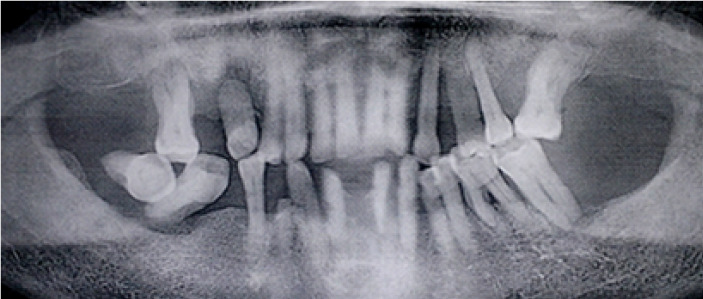 Prevalence and severity of periodontitis among adults in Côte d'Ivoire according to the new EFP/AAP periodontal disease classification.