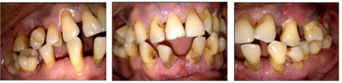 Prevalence and severity of periodontitis among adults in Côte d'Ivoire according to the new EFP/AAP periodontal disease classification.