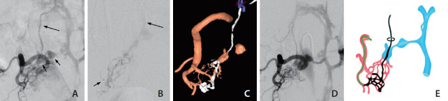 Embolization Tactics of Spinal Epidural Arteriovenous Fistulas.