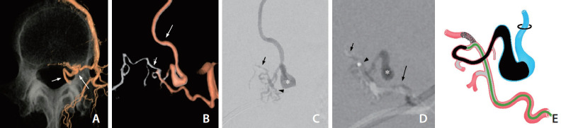 Embolization Tactics of Spinal Epidural Arteriovenous Fistulas.