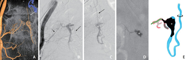 Embolization Tactics of Spinal Epidural Arteriovenous Fistulas.