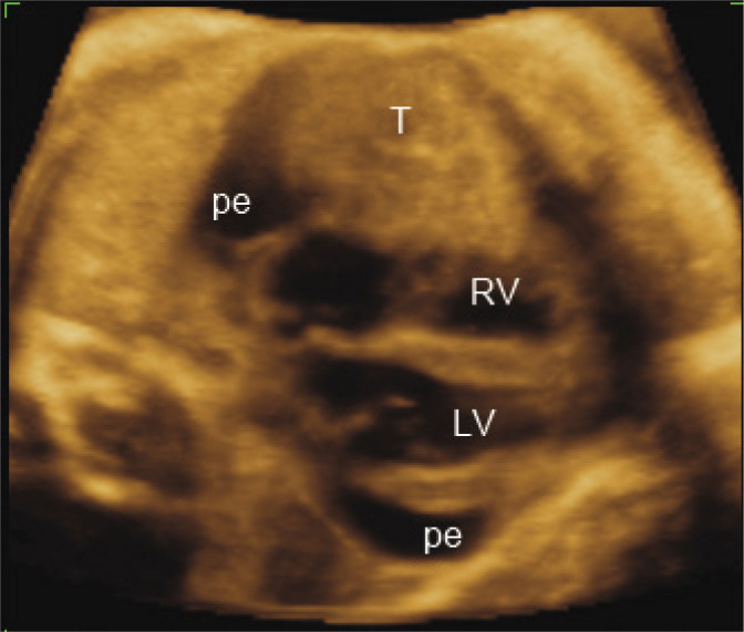 Liver herniation into the pericardium mimicking a pericardial tumor: unusual presentation of trisomy 13.