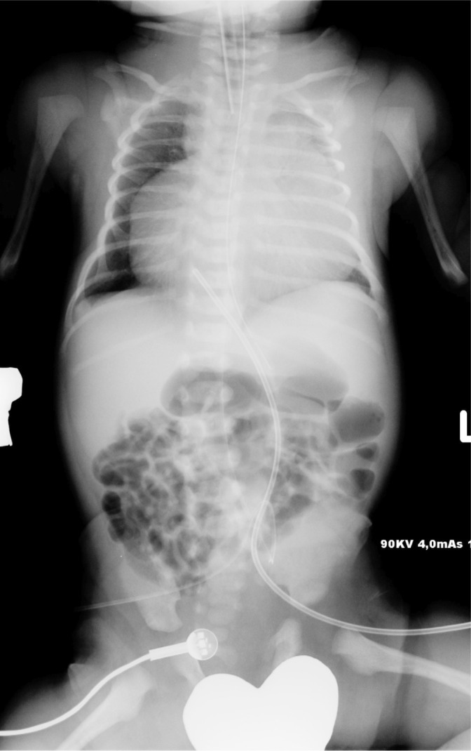 Liver herniation into the pericardium mimicking a pericardial tumor: unusual presentation of trisomy 13.