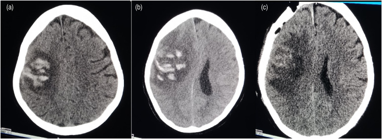 Massive haemorrhage: an unusual presentation of systemic lupus erythematosus.