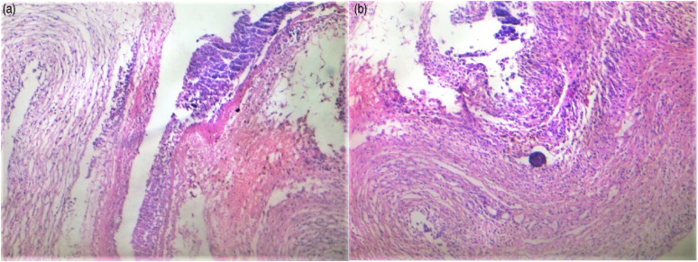 Massive haemorrhage: an unusual presentation of systemic lupus erythematosus.