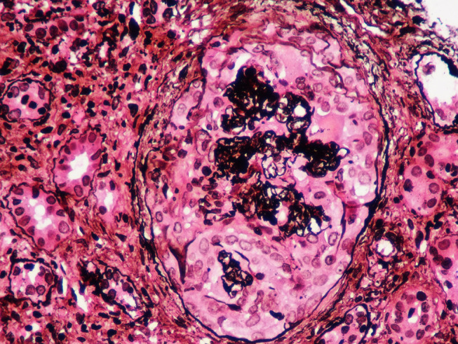 Temporal Clustering of Antiglomerular Basement Membrane Disease in COVID-19 Pandemic: A Case Series.