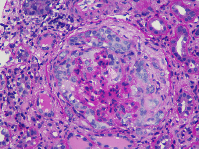 Temporal Clustering of Antiglomerular Basement Membrane Disease in COVID-19 Pandemic: A Case Series.