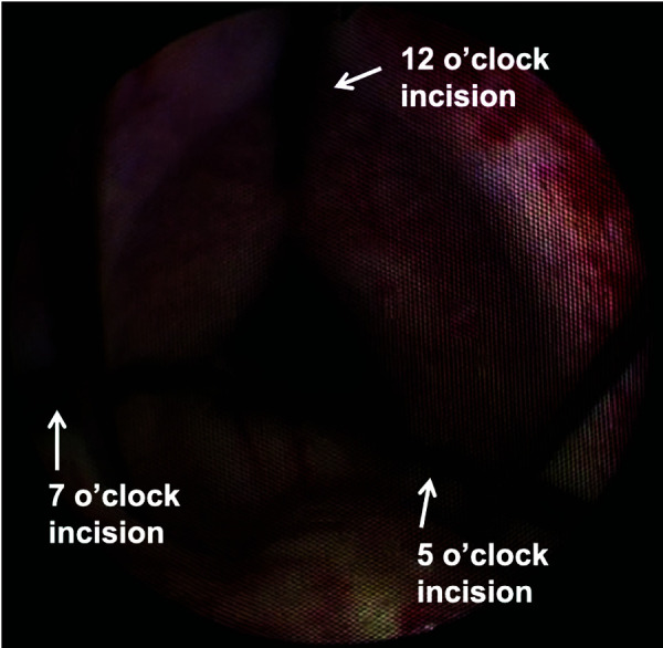 iTIND for BPH: Technique and procedural outcomes: A narrative review of current literature.