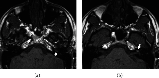 Intracochlear Hemorrhage: A Rare Cause of Sudden Sensorineural Hearing Loss.