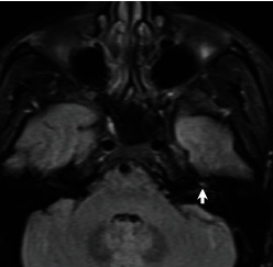 Intracochlear Hemorrhage: A Rare Cause of Sudden Sensorineural Hearing Loss.