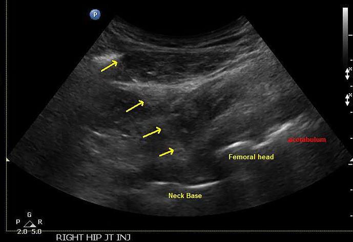 Value of ultrasound-guided aspiration of hip arthroplasties performed in an orthopedic clinic by orthopedic surgeons.