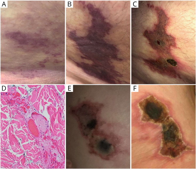 Nicolau Syndrome After Glatiramer Acetate Injection in Close Proximity to Administration of SARS-CoV-2 mRNA Vaccine.
