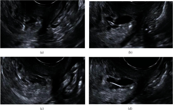 Treatment of Cervical Pregnancy with Ultrasound-Guided Intragestational Injection of Methotrexate: A Case Report.