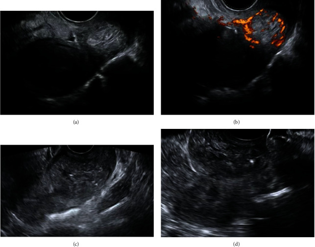 Treatment of Cervical Pregnancy with Ultrasound-Guided Intragestational Injection of Methotrexate: A Case Report.